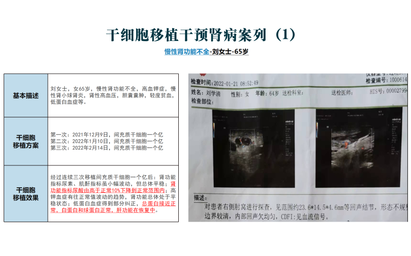 干细胞移植干预肾病
