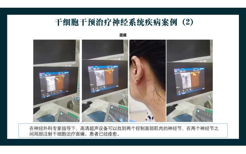 干细胞干预治疗神经系统面瘫疾病案例