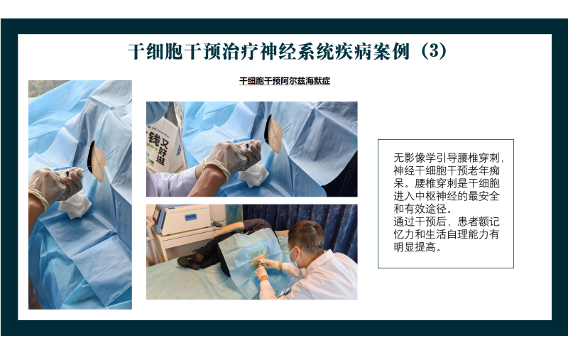 干细胞干预治疗神经系统疾病案例-干细胞干预阿尔兹海默症