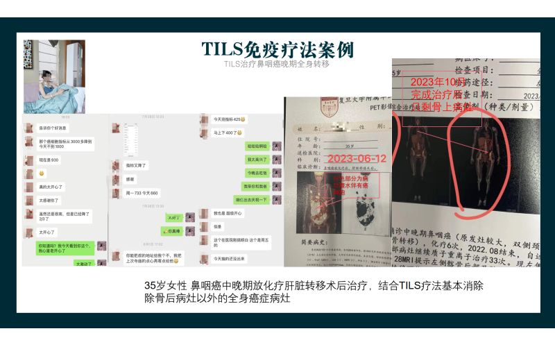 TILS免疫疗法案例-疗鼻咽癌晚期全身转移